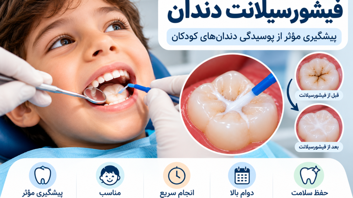 تصویر آموزشی فیشورسیلانت دندان و پوشاندن شیارهای دندان آسیاب برای پیشگیری از پوسیدگی در کودکان